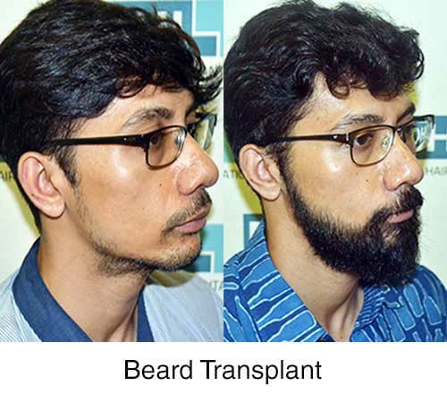 Beard transplant