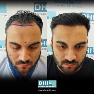 Before and After Hair Transplant Surgery Results
