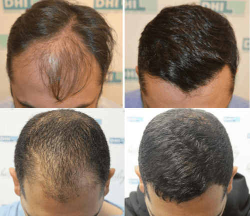Hair Transplant Cost DHI