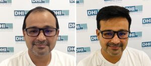 Before  and After Results 