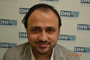 Shaad Rahman Before Hair Transplant 