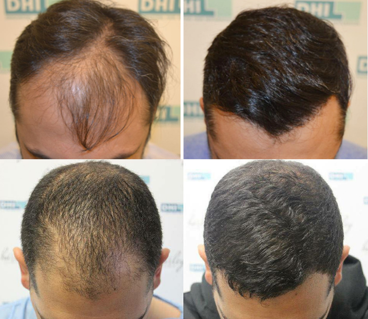 Hair Transplant Cost DHI