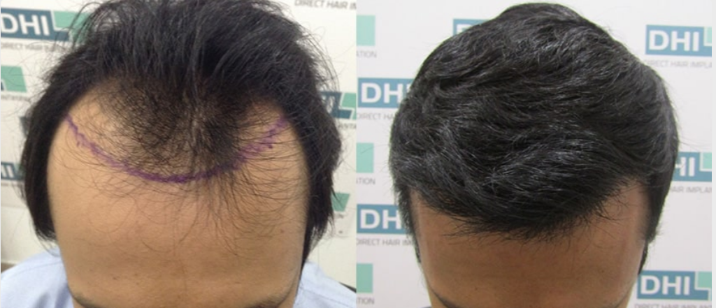 Hair Transplant Cost DHI 10