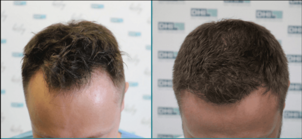 Hair Transplant Cost DHI 11