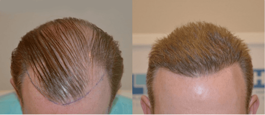 Hair Transplant Cost DHI 12