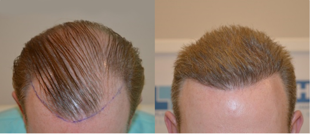 Hair Transplant Cost DHI 12