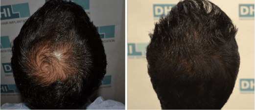 Hair Transplant Cost DHI 13