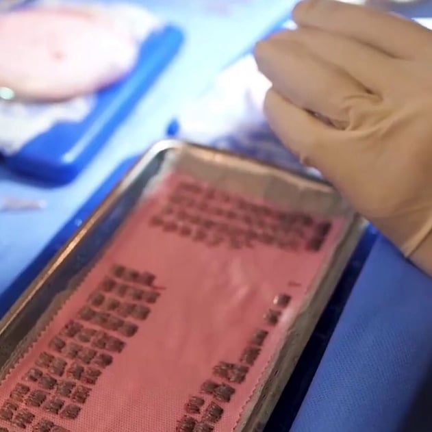 Hair Transplant Procedure in DHI India