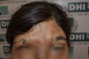Eyebrow transplant for acid burnt victim