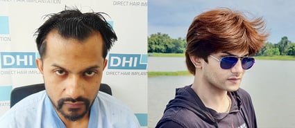 Sudipto Dass Hair Transplant at DHI India, like Shahrukh Khan hairstyle