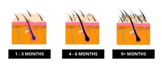 Laser Light Therapy Promotes Hair Growth