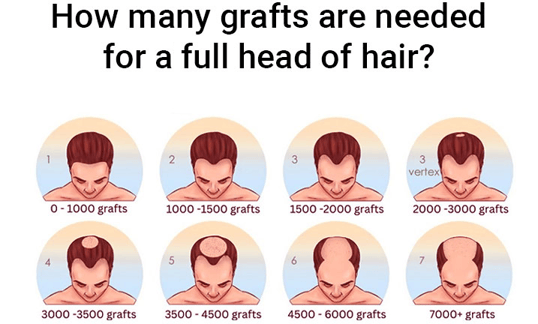How many grafts are needed for a full head of hair