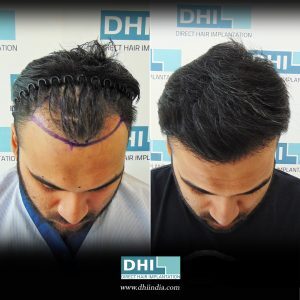 Before and After Results - DHI India