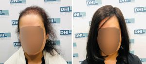 DHI Hair Transplant Before & After Results