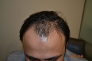 Shaad Rahman Before Procedure Hair Transplant at DHI 