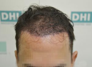 After 2 days of implantation - DHI