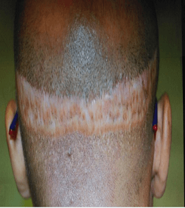 Hair Transplant Cost DHI 5