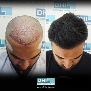 MD. Zaid Asraf Before and After Hair Transplant Results