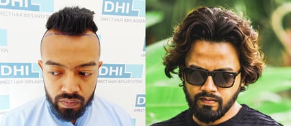 Swoujas’s After Hair Transplant Results