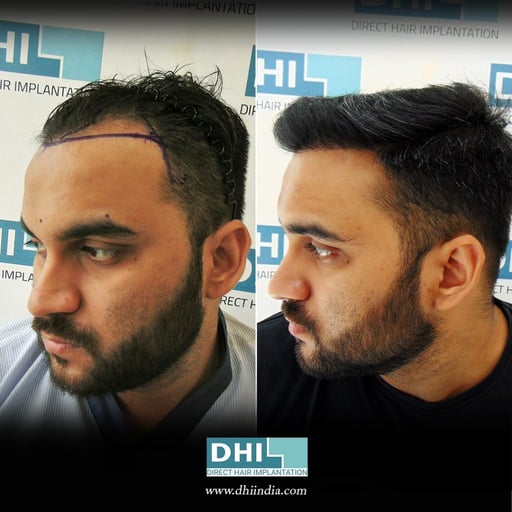 Hair Transplant Surgery Results - DHI India