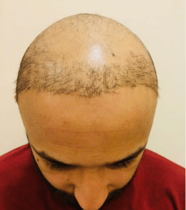 Hair Transplant Cost DHI 2