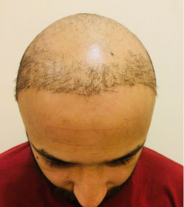 Hair Transplant Cost DHI 2