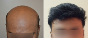 Hair Loss Treatment Before  and After Results 