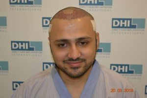 DHI Hair Transplant Journey of a young business owner 3