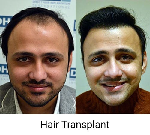 DHI hair transplant