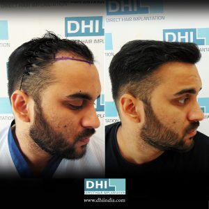 Before and After Hair Transplant Results