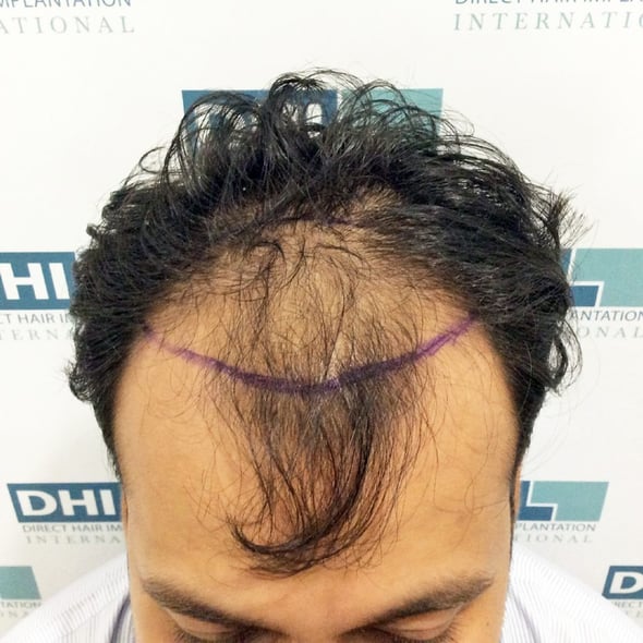 Before DHI Hair Transplant Procedure