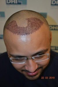 Shaad Rahman  Hair Transplant  - 1 Day After Procedure
