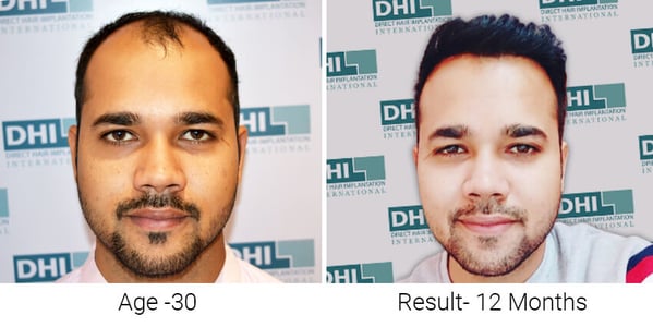 Before and After 12 Months Results 