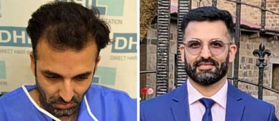 Hair Transplant Before After Results