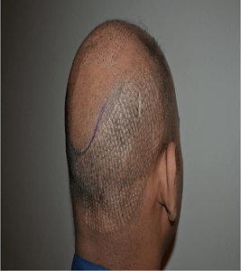 DHI Hair Transplant Cost 