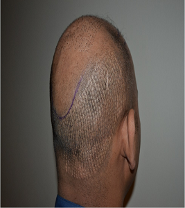 DHI Hair Transplant Cost 