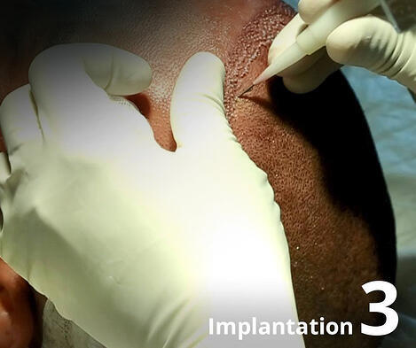 Hair Transplant Implantation 3