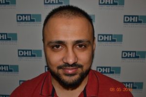 DHI Hair Transplant Journey of a young business owner 5