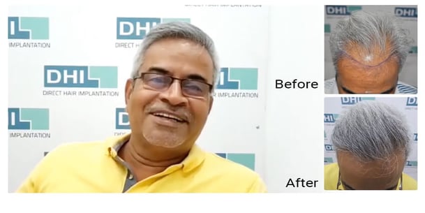 Hair Treatment Before and After Results 