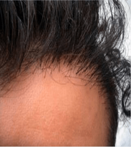 DHI Hair Transplant Cost in India