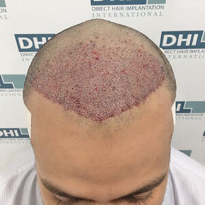 After DHI Hair Transplant Procedure