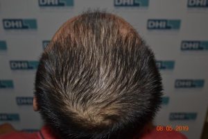 DHI Hair Transplant Journey of a young business owner 6