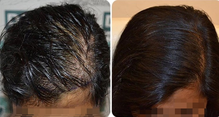 female hair transplant results- DHI