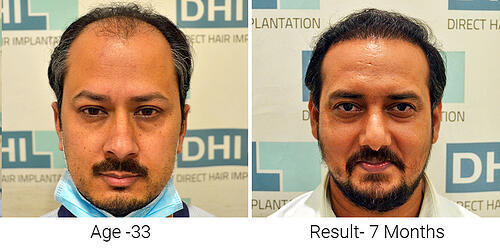 Men Hair Transplant Results After 7 Months