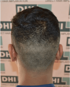 Hair Transplant Cost DHI 7