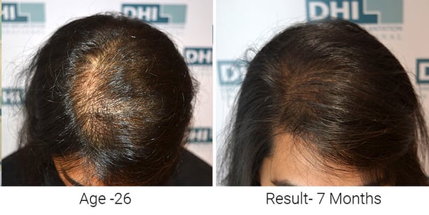 Female Hair Transplant Results After 7 Months