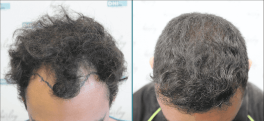 Hair Transplant Cost DHI 8