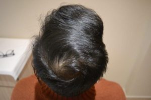 Shaad Rahman Hair Transplant at DHI India