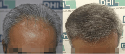 Hair Transplant Cost DHI 9