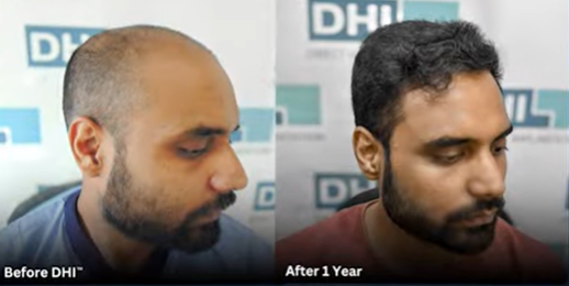After 1 Year Hair Transplant